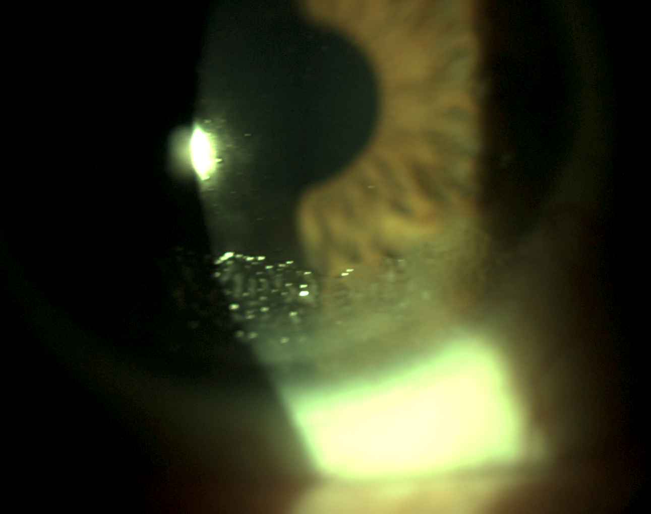 Lipid Deposits on Contact Lens 1